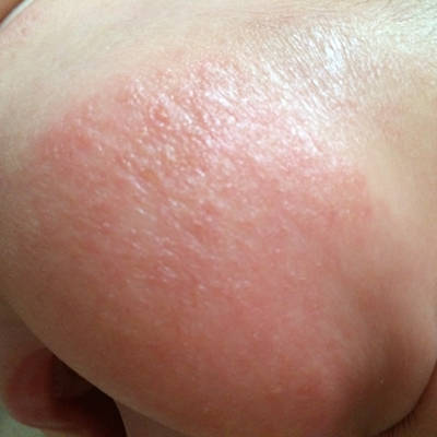 我家宝宝三个月不知道脸部一边红红的有点乾巴巴的