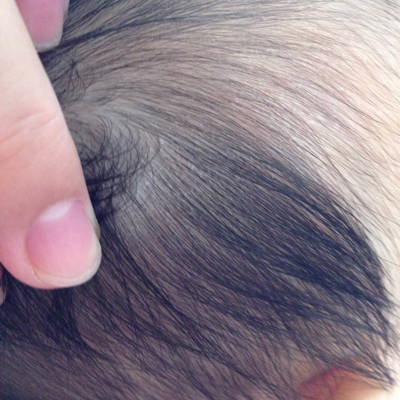 我家宝宝4个半月了,头发里突然有头皮屑,很乾燥,并且老是挠,挠的都