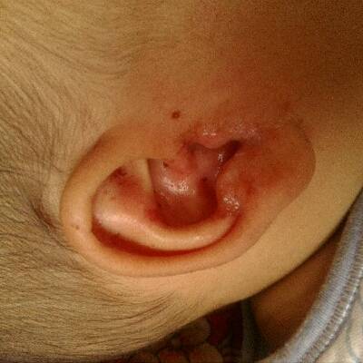 耳甲腔长脓包图片图片