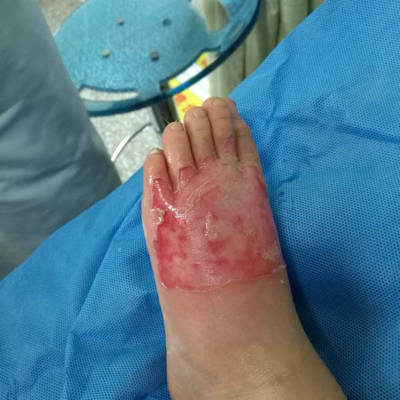 宝宝脚烫伤了,去医院换了两次药,宝宝到医院就害怕一直哭闹,我想在家