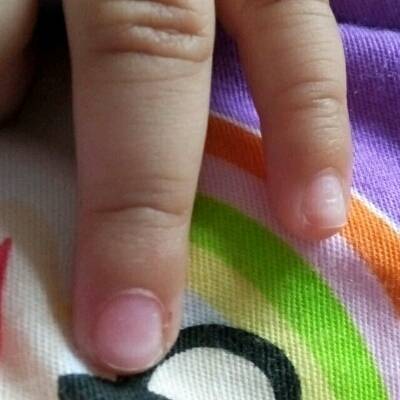 孩子指甲凹凸不平图片图片