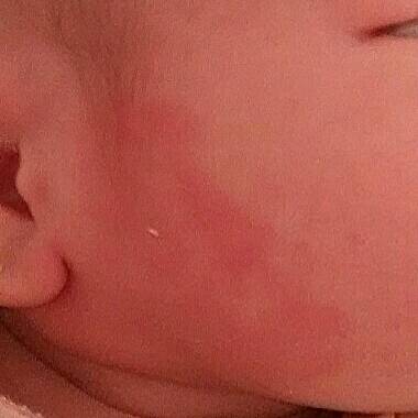 新生儿面部红色胎记图片