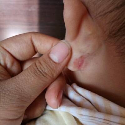 可以帮我看看宝宝耳朵后面裂口是怎麼回事吗?