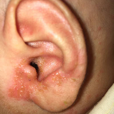 54天婴儿耳朵溃烂怎麼处理?可以用药吗?