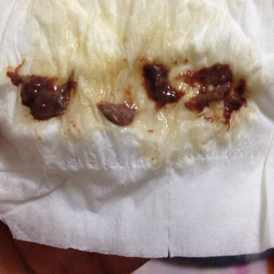 我现在怀孕12周,今天和老公生气生的很厉害,刚刚去了趟厕所用纸擦下面