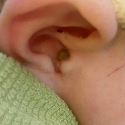 5月龄女宝宝耳朵裏面有黄色水,有点像脓水一样,急求大夫专家帮忙谢谢