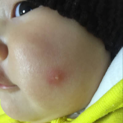 6个月零2天的宝宝,脸上长了一个水泡,透明有浓水
