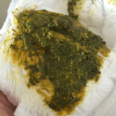 7个月宝宝拉绿便,母乳餵养,基本没添加辅食,而且睡