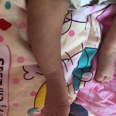 15个月宝宝罗圈腿图片图片
