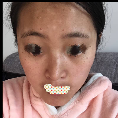 以前没注意,现在7个多月,没扩散,但也不下去,黄褐斑我不怕,可是这白斑