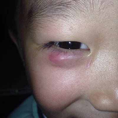 儿童眼睑内腺囊肿图片图片