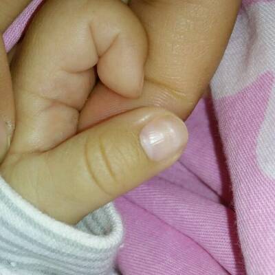 两个月的宝宝手指甲上有这种白色凸起的横杠是怎麼回事?