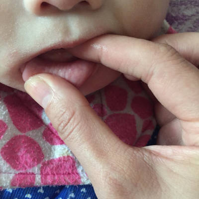 婴儿牙龈外侧白色硬包图片
