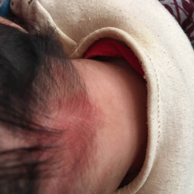婴儿后颈部鲜红斑痣图片