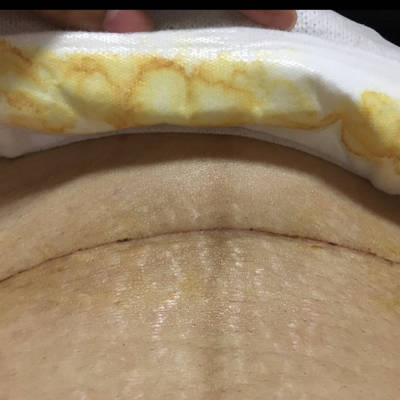 剖腹产后8个月伤口图图片