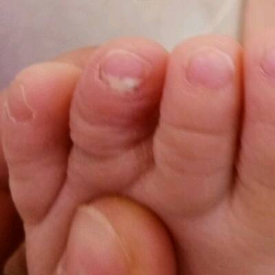 2周岁宝脚指甲长半截白色指甲怎麼回事