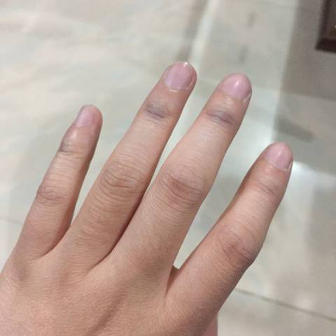 为什麼我的手指关节会发黑,跟怀孕有关吗?