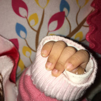 宝宝的手指甲下方为什麼会变黑色了,是什麼原因呢?