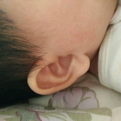 耳朵银屑病图片