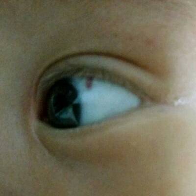 我宝宝2个多月白眼球有一竖血快是为什麼啊,要不要紧,急