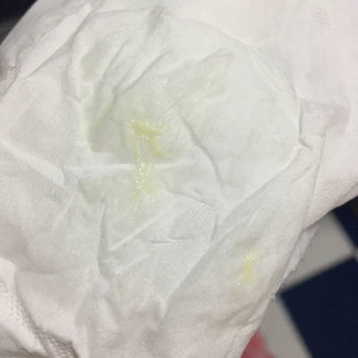 白带黄绿色炎症图片