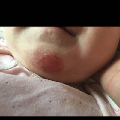 宝宝湿疹感染化脓图片图片