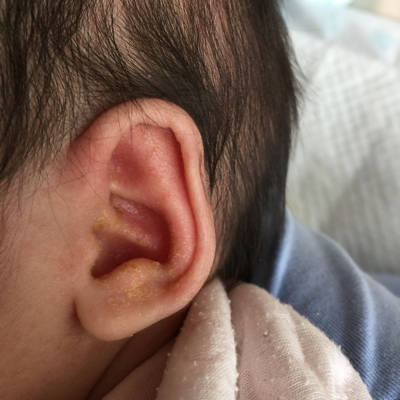 宝宝耳朵长癣图片图片