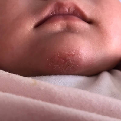 我家宝宝四个多月,最近发现孩子下巴红红的,而且好像还破皮了,有什麼