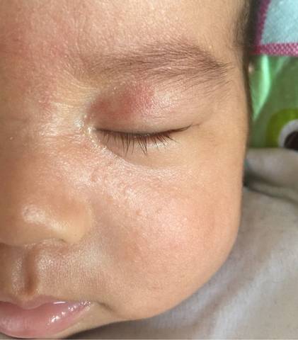 宝宝两个多月,前天带宝宝去医院检查才知道眼皮上的一块红叫血管瘤