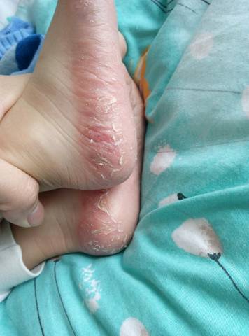 病毒性皮疹 手脚图片