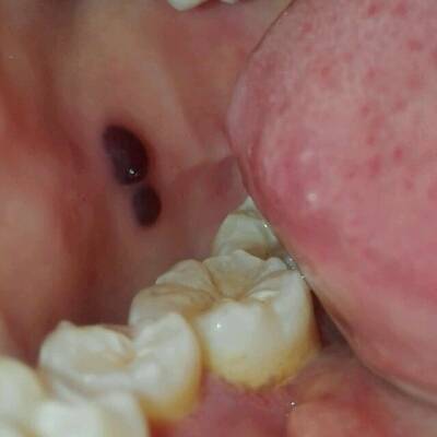 嘴巴里的黑血泡的图片图片