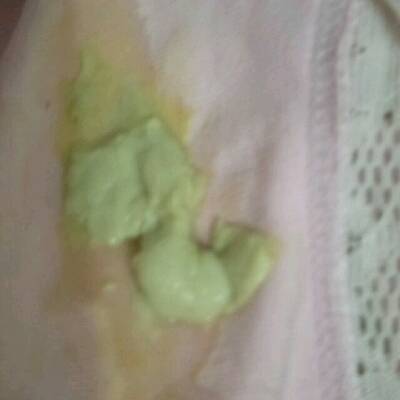 急急急有孕晚期白带是黄绿色呈块状的吗?