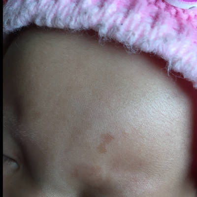 宝宝脸上淡淡的咖啡斑图片