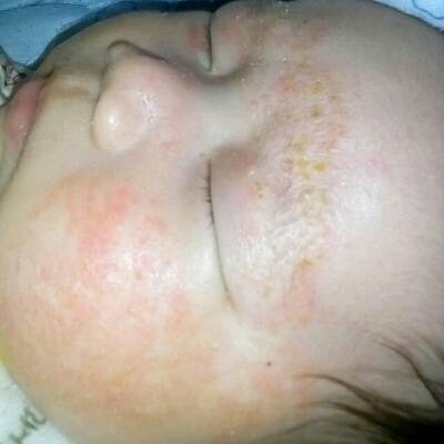 婴儿脸上有出血点图片图片