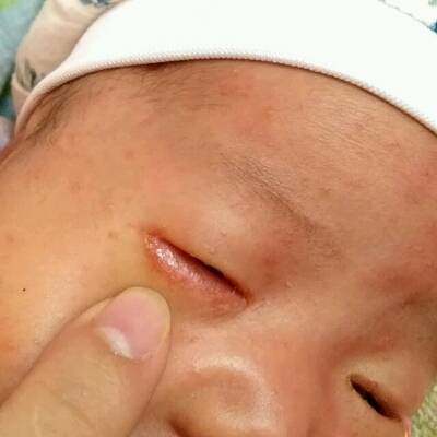 婴儿眼角起湿疹图片图片