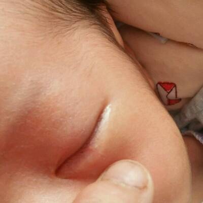 宝宝12天了,今天发现下眼皮里面起了一个小红疙瘩,严重吗,比较担心