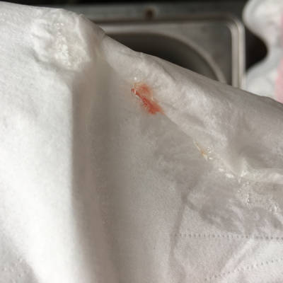 你好,我怀孕七个月,可是连续一个月鼻腔都有血,吐