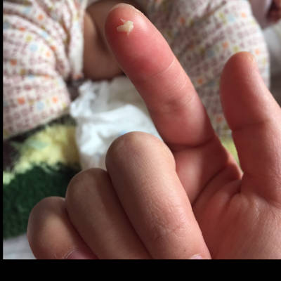 3岁女宝宝尿道口红痒图片