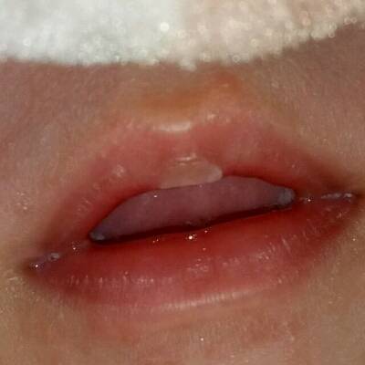 宝宝嘴唇上面这个是什麼要治疗吗?
