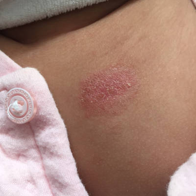 婴儿皮肤病癣图片图片