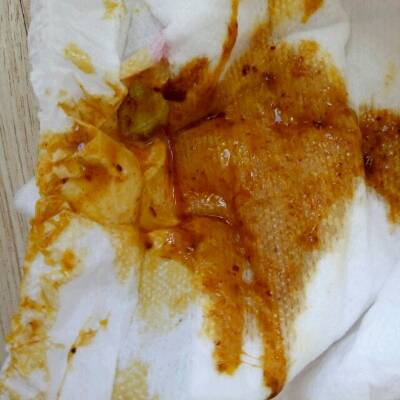 宝宝天天拉稀拉这样的正常吗