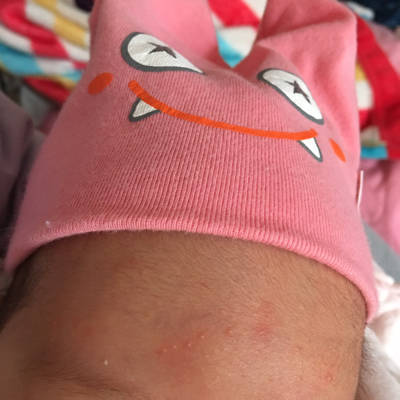 我家宝宝额头上面这是什麼啊,是不是湿疹啊