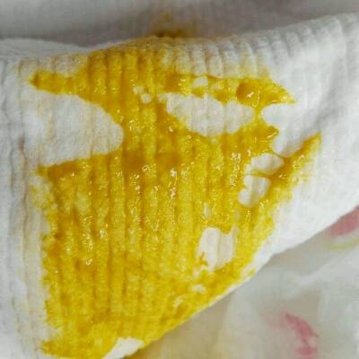 母乳餵养,可是他的大便一直都挺多的,基本上天十来次,多多少少都有,是