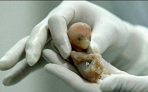 11周药流排出成型胎儿图片