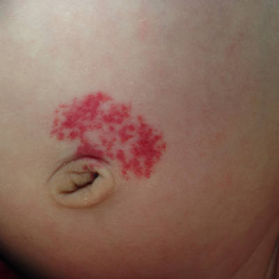 宝宝肚脐发红图片大全图片