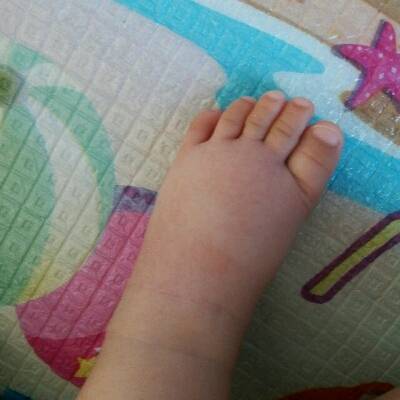 宝宝的脚踝突然肿了图图片