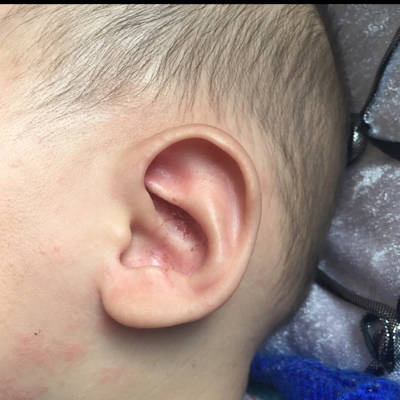 婴儿外耳湿疹症状图片图片