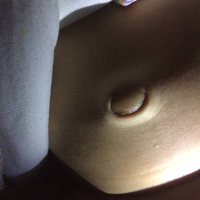婴儿肚脐正常图图片