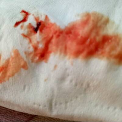 纸巾血迹图片图片