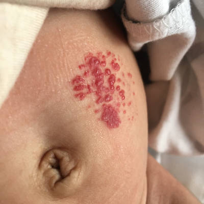 宝宝身上血管瘤的图片图片